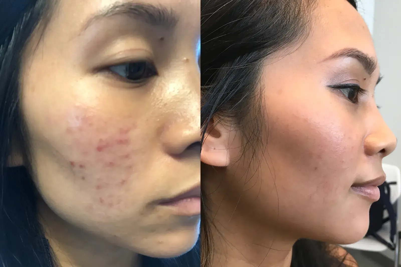 Acne, patient 1, photo 2 of 4: before and after