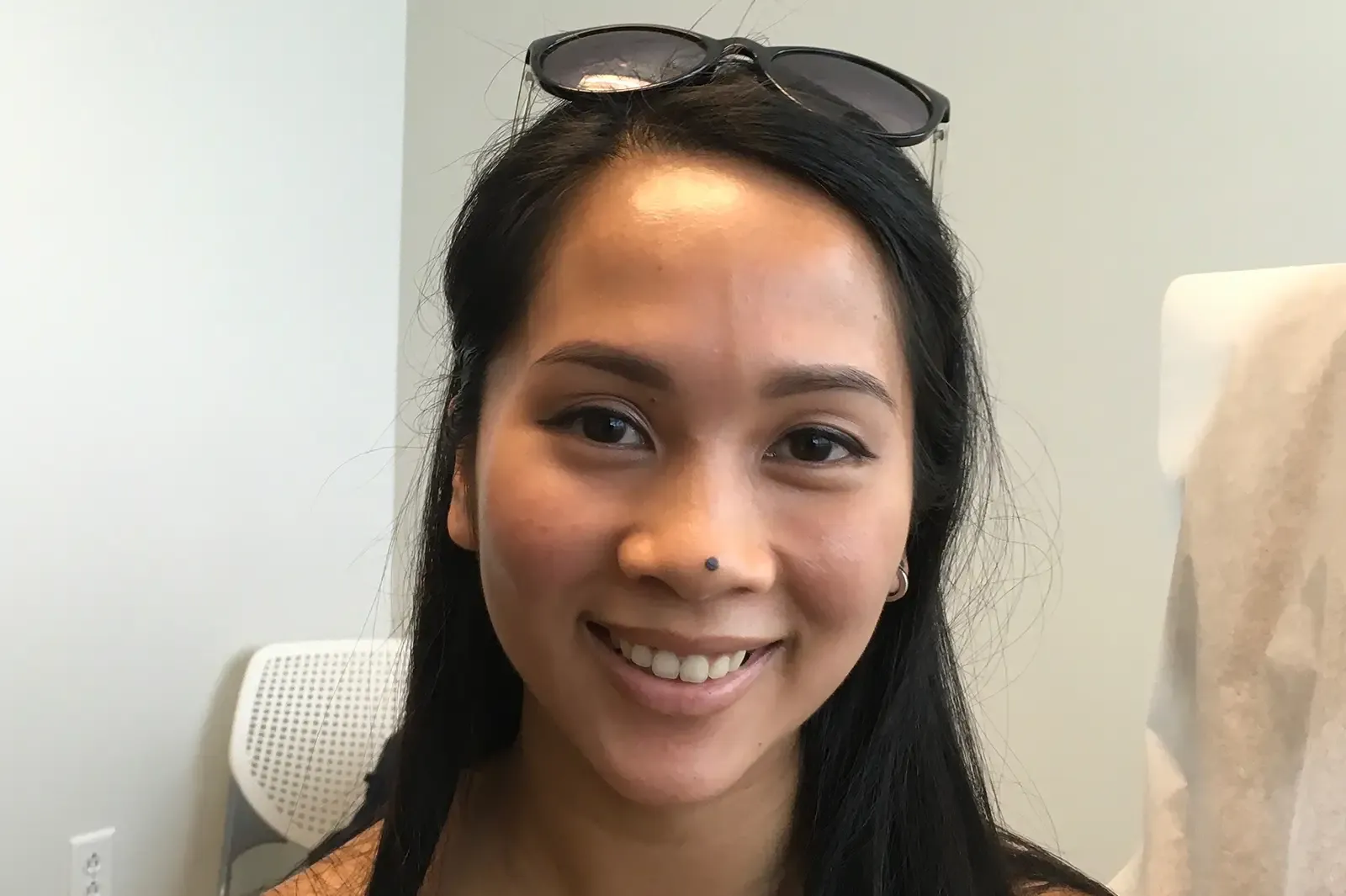 Acne, patient 1, photo 4 of 4: before and after