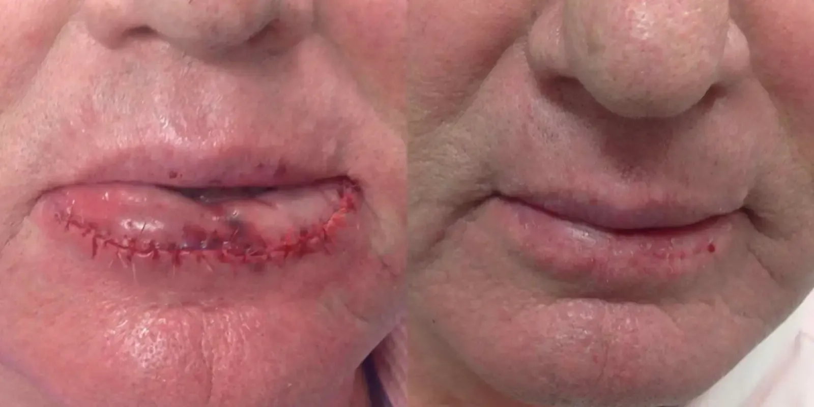 Mohs Surgery, patient 11, photo 2 of 2: before and after