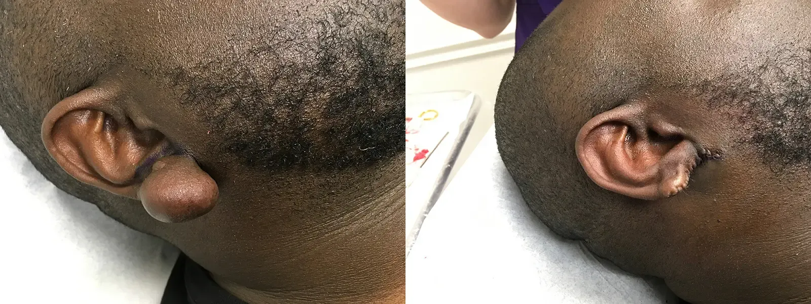 Keloid Excision, patient 12, photo 1 of 3: before and after