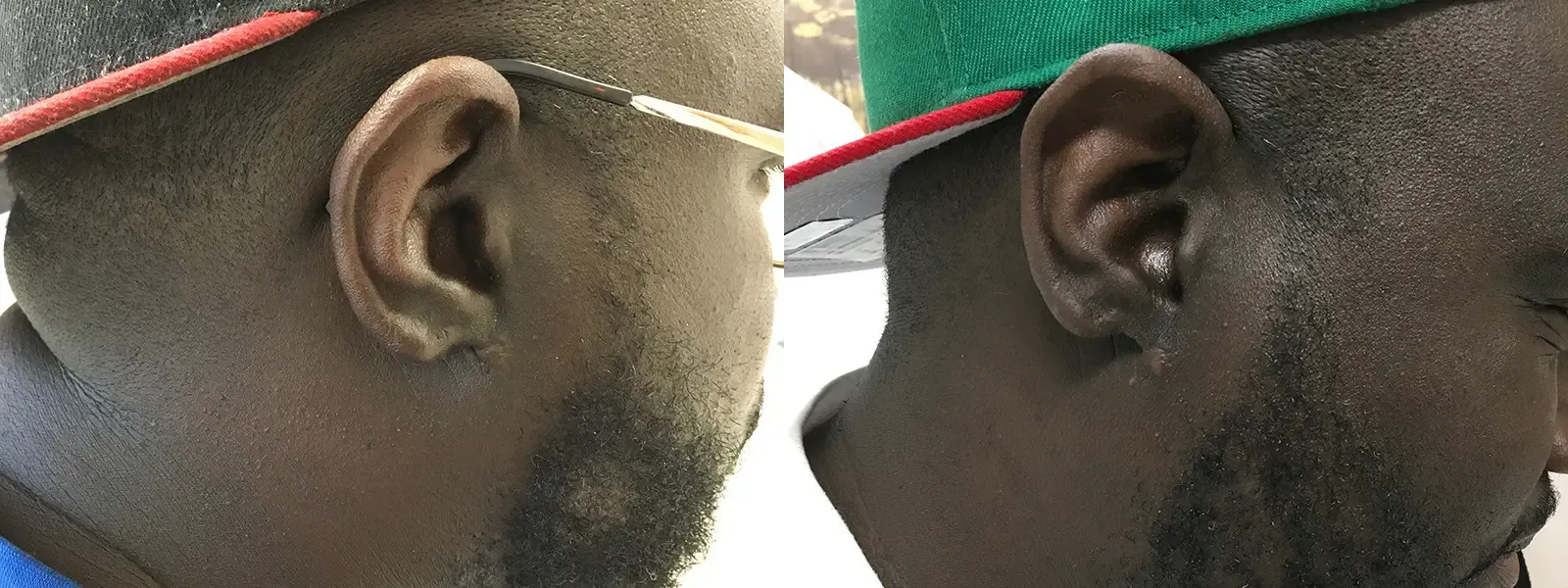 Keloid Excision, patient 12, photo 3 of 3: before and after