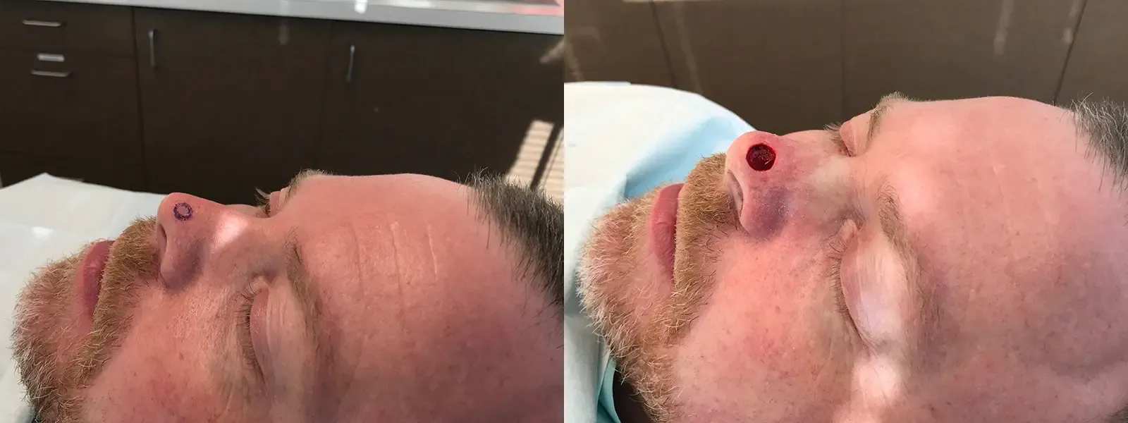 Mohs Surgery, patient 14, photo 1 of 3: before and after