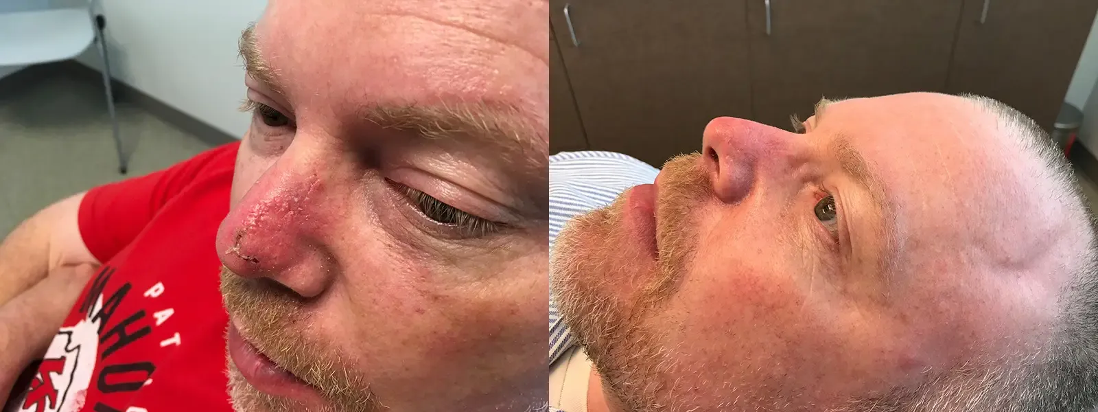 Mohs Surgery, patient 14, photo 3 of 3: before and after