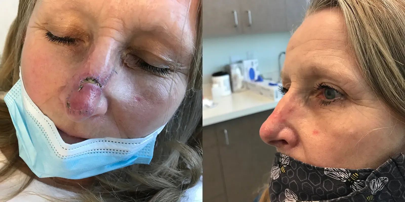 Mohs Surgery, patient 15, photo 1 of 3: before and after