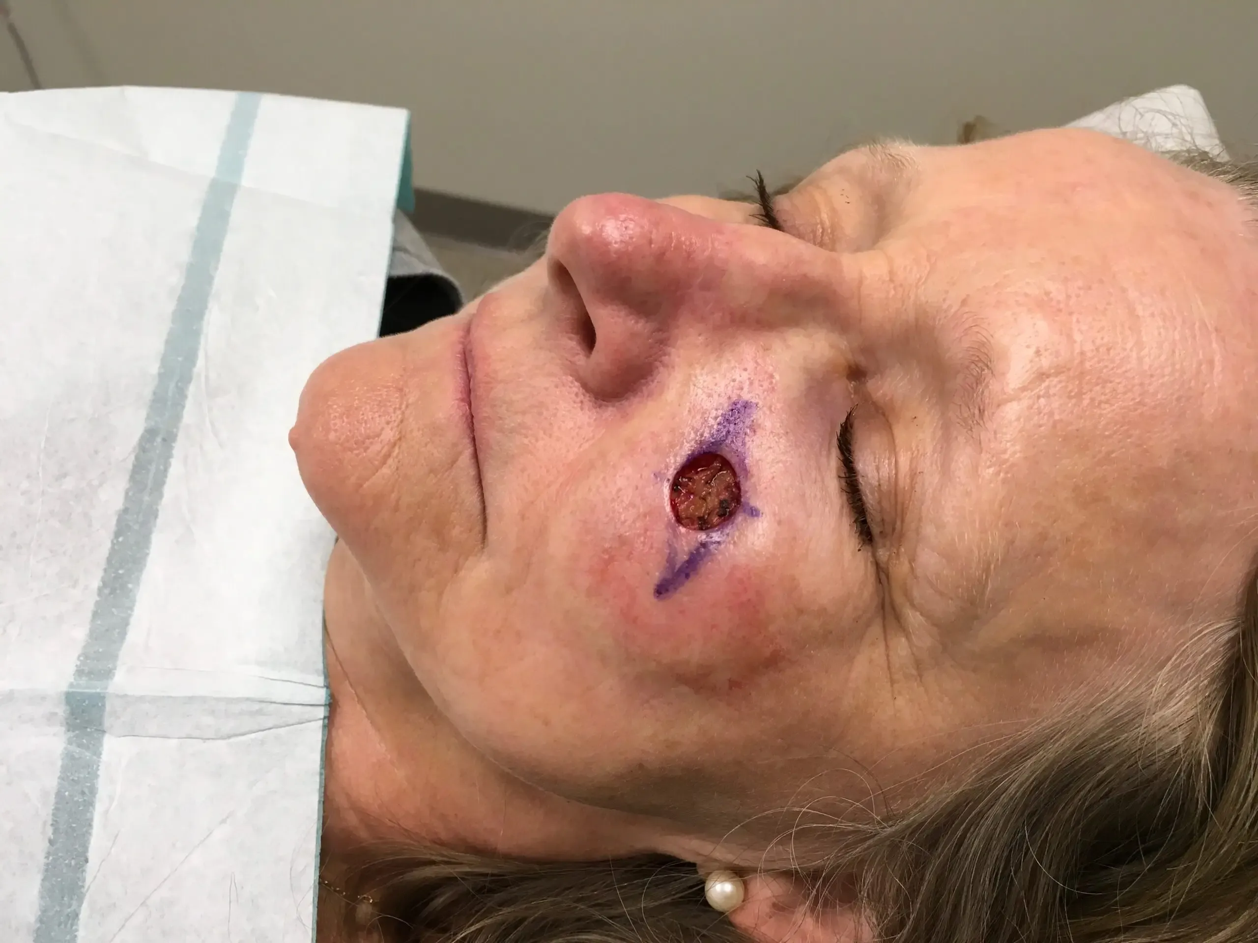 Mohs Surgery, patient 15, photo 3 of 3: before and after