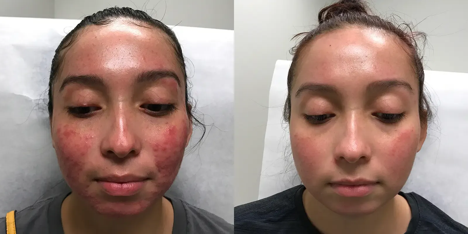 Acne, patient 2, photo 1 of 3: before and after