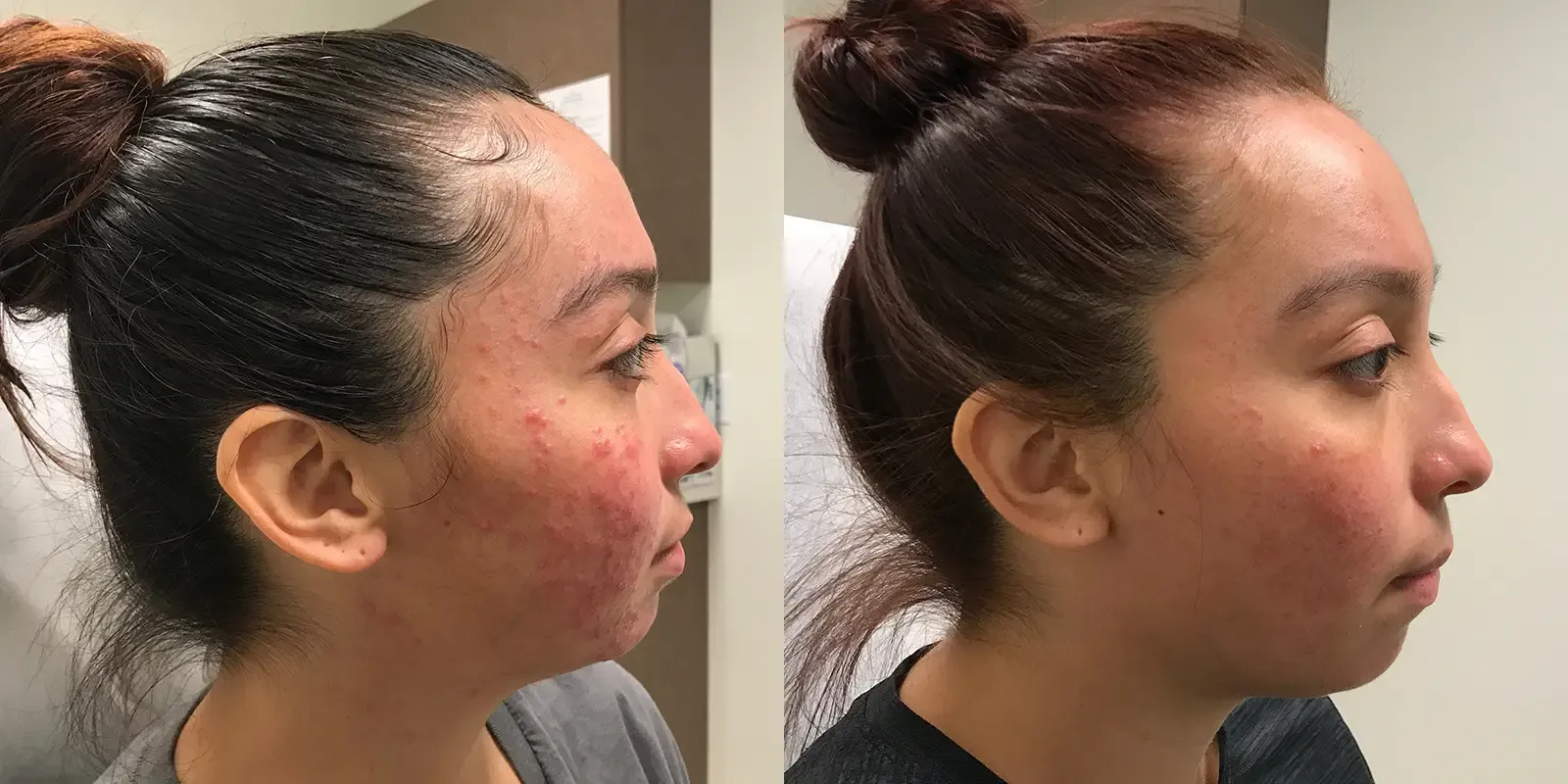 Acne, patient 2, photo 2 of 3: before and after