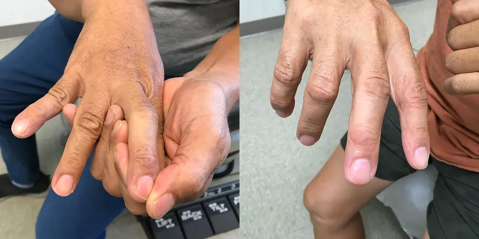 Rash, patient 3: before and after