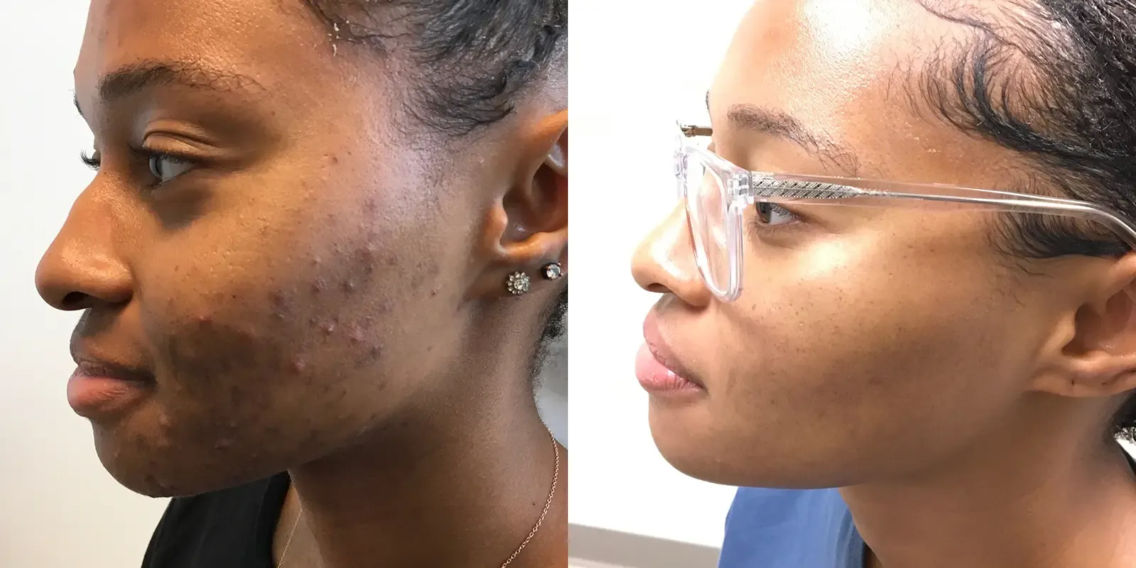 Acne, patient 5, photo 2 of 2: before and after
