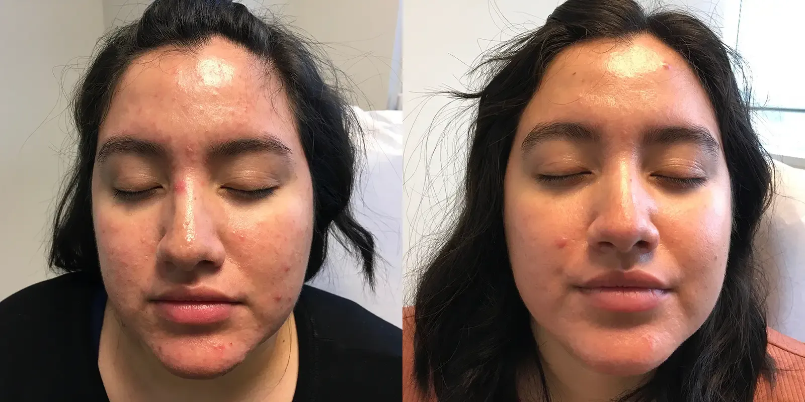 Acne, patient 6: before and after