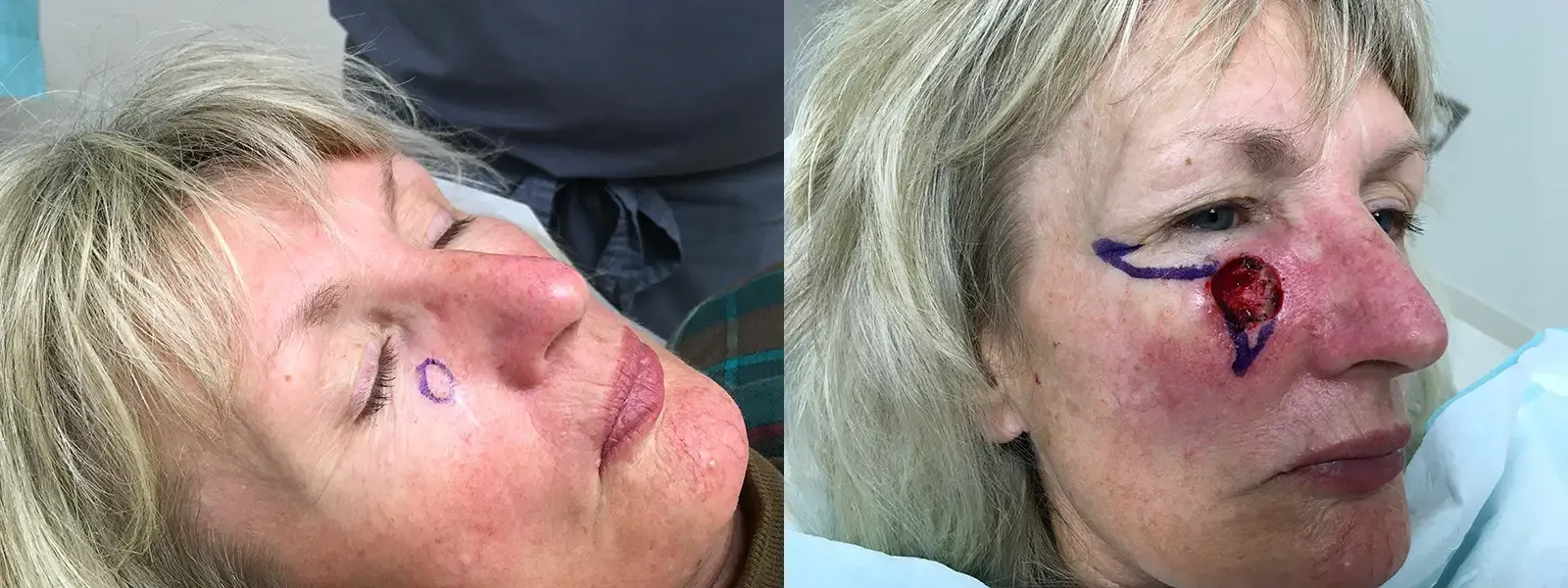 Mohs Surgery, patient 9, photo 1 of 5: before and after