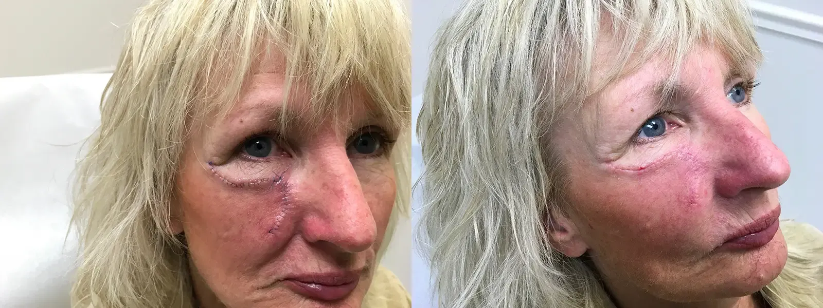 Mohs Surgery, patient 9, photo 4 of 5: before and after