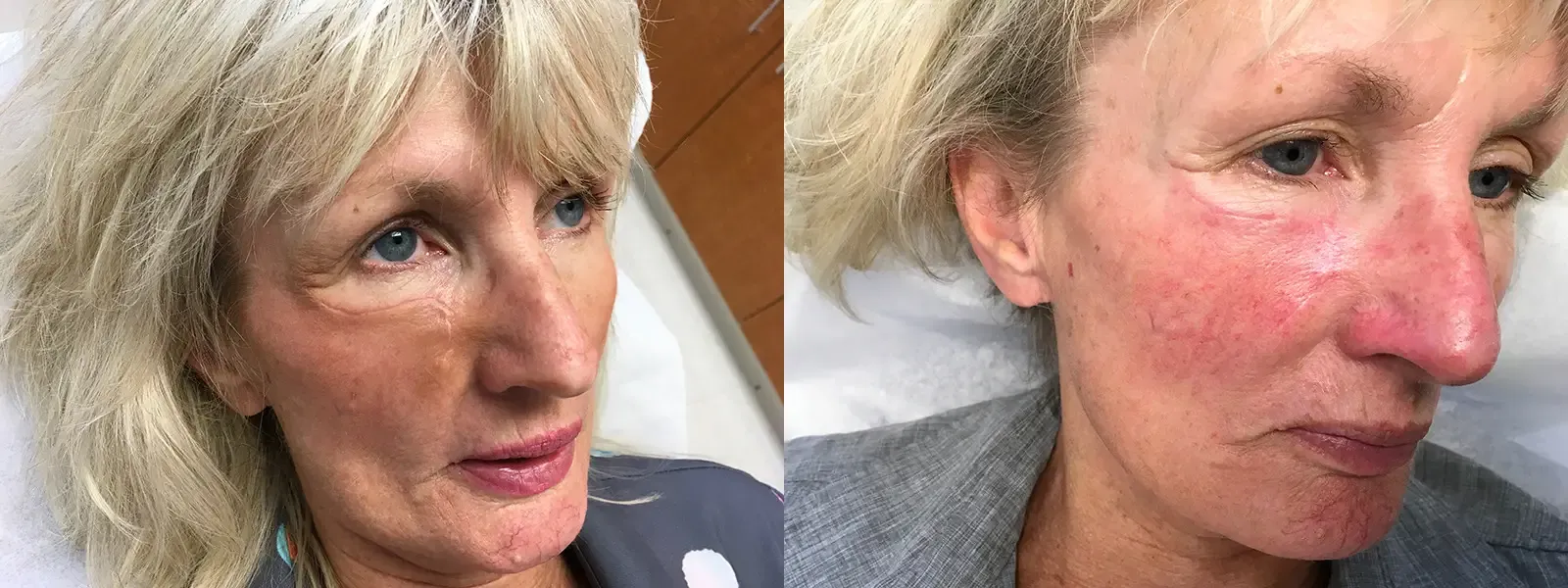 Mohs Surgery, patient 9, photo 5 of 5: before and after