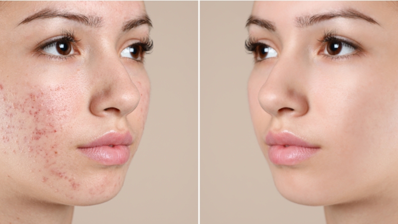 Benefits of acne extraction before and after