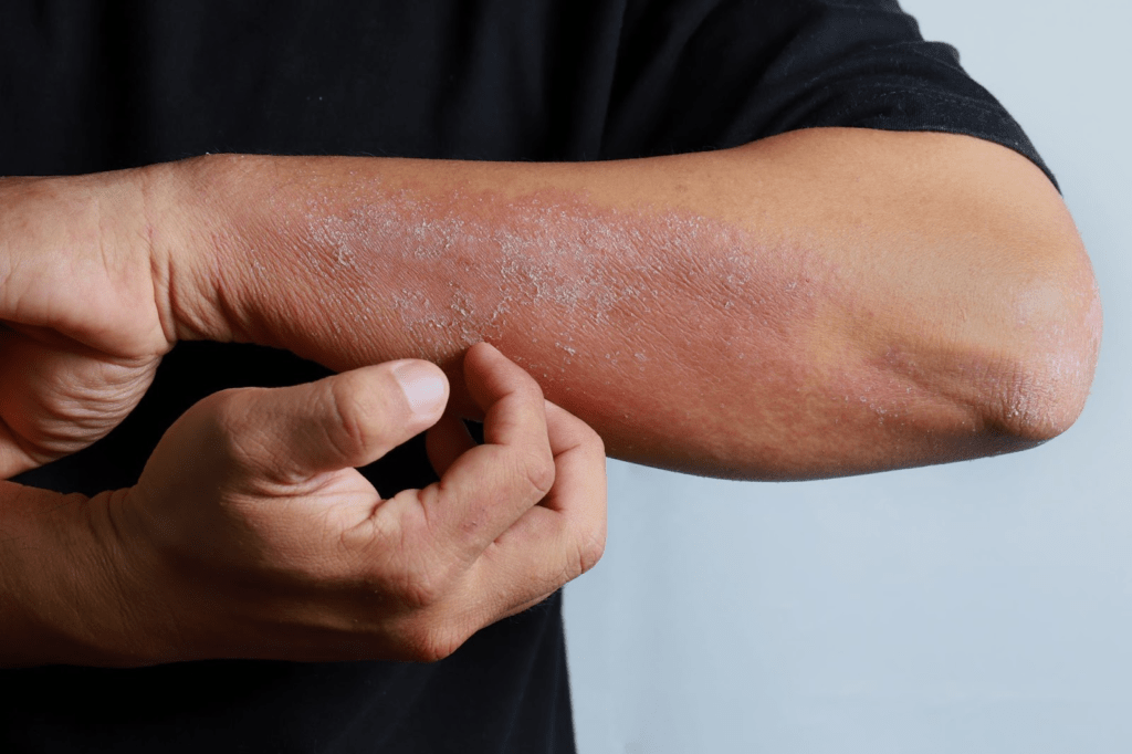 Dry, inflamed patches of skin characteristic of eczema
