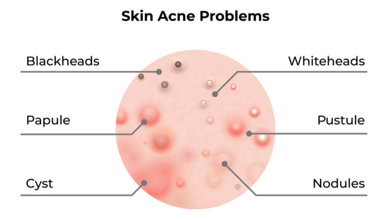 Types of Acne