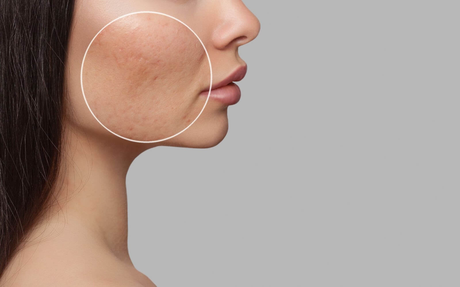 acne scars - Team Dermatology