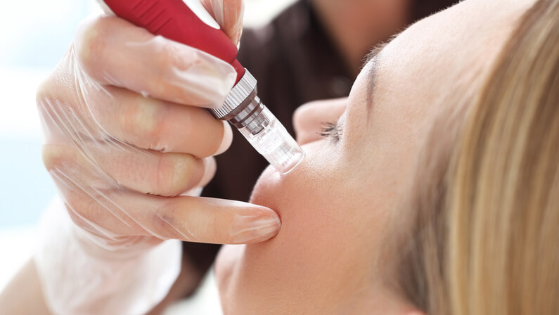 Microneedling
