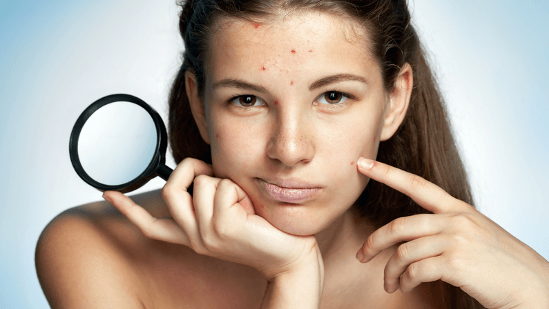 acne treatment