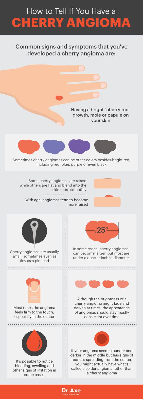 cherry angioma explained