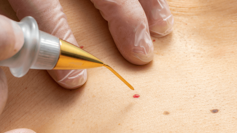 cherry angiomas treatment