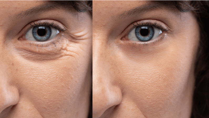 crows feet treatment
