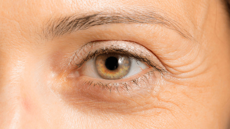 crows feet