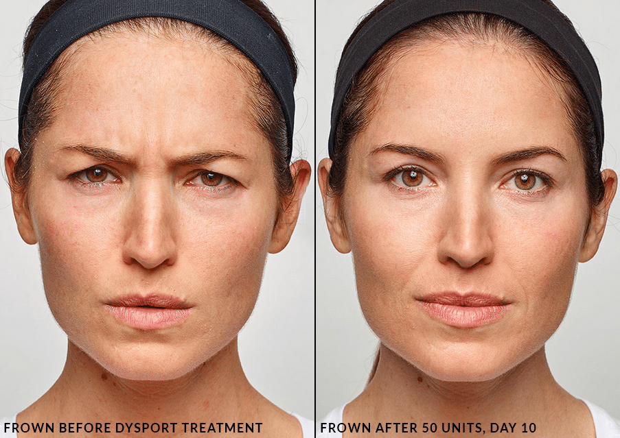 dysport treatment