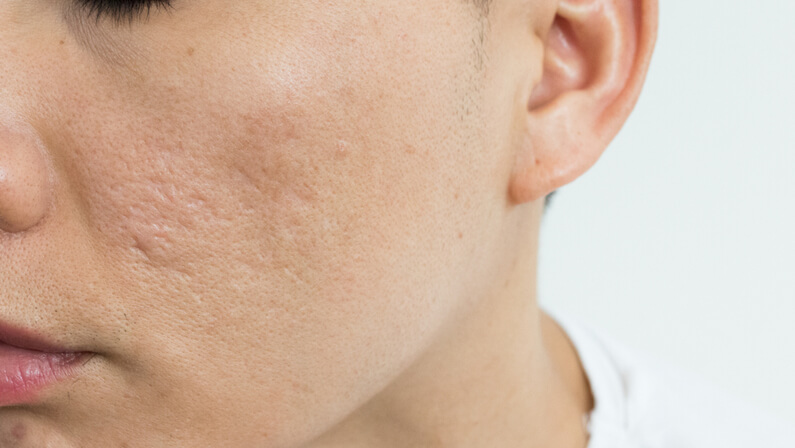 ice pick scars on face