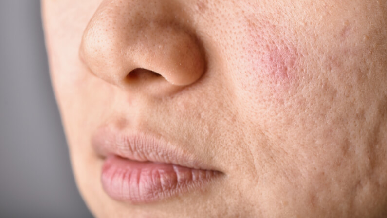 pockmarks in the face