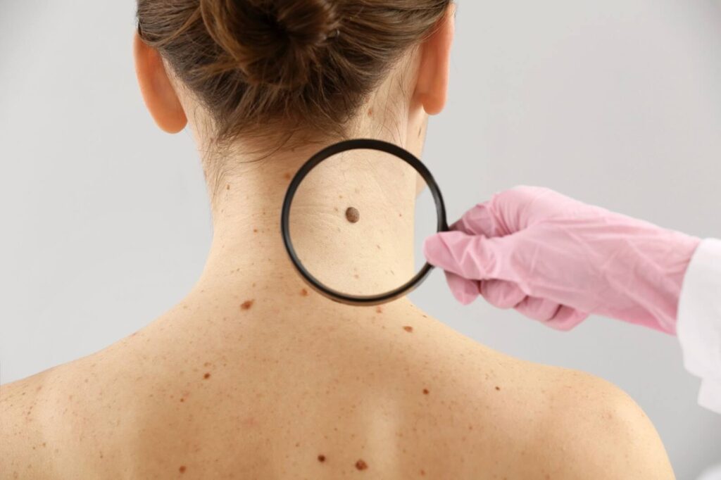 regular skin checkups - Team Dermatology
