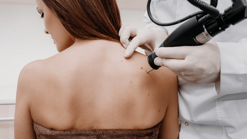 wart treatment