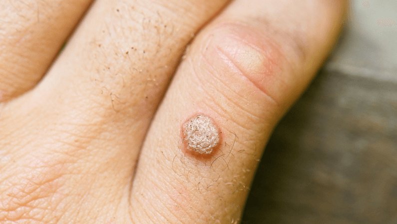 wart