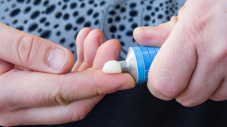Topical corticosteroids for Dyshidrotic Eczema