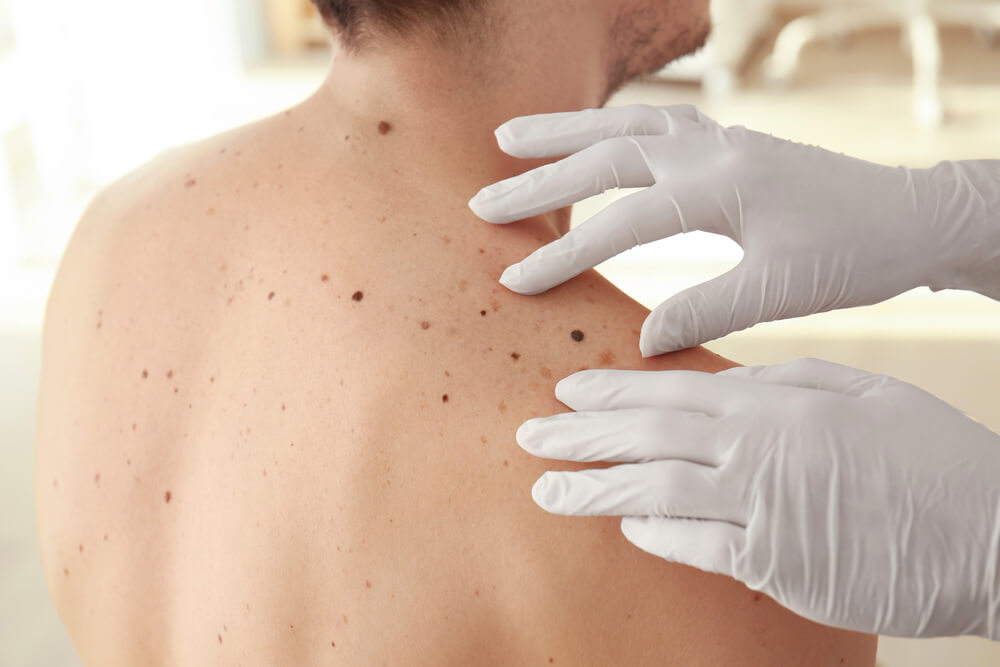 A healthcare professional in white gloves examines a patient&apos;s back for skin abnormalities, including moles and spots. The image highlights the importance of regular skin checks for early detection of potential issues, such as skin cancer. The patient&apos;s skin shows various moles, emphasizing the need for monitoring changes in size, shape, or color. This visual serves to promote awareness about skin health and encourages individuals to seek professional evaluations for skin concerns.