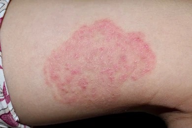 Close-up image of a red, inflamed patch of skin on a person&apos;s arm, showing symptoms of a skin condition. The area appears raised with a scaly texture, indicating possible eczema or psoriasis. The skin surrounding the affected area is healthy, highlighting the contrast. This image is useful for educational purposes related to dermatological conditions and skin health awareness.