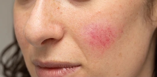 Close-up of a woman&apos;s face showing a red rash on her cheek, indicating a skin condition or irritation. The image highlights the texture and color variations of the skin, with visible freckles and natural facial features. This visual representation is useful for discussions on dermatological issues, skincare treatments, or personal health awareness.