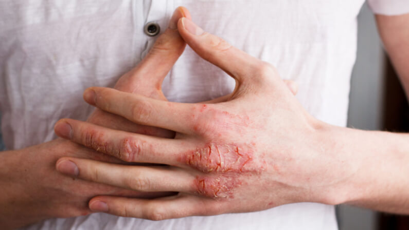 Eczema