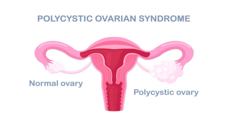 Polycystic ovary syndrome