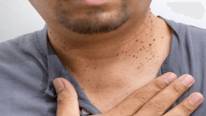 male neck with skin tags