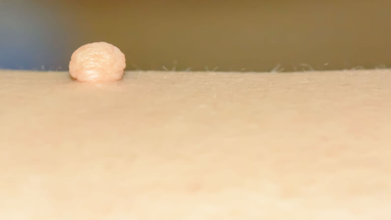 symptom of skin tag