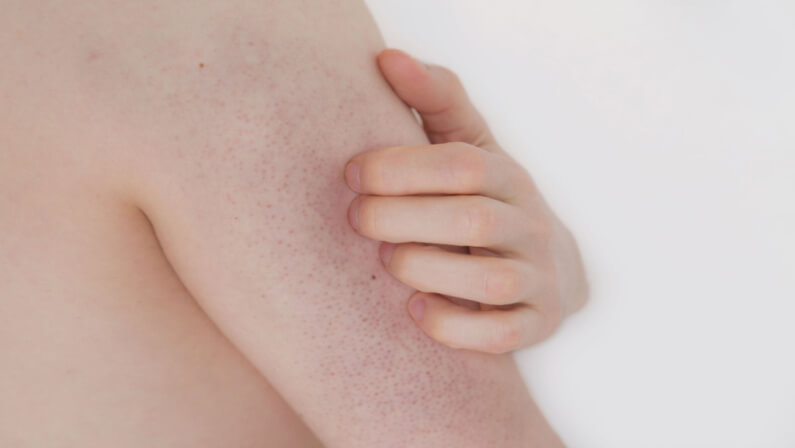 keratosis pilaris on skin