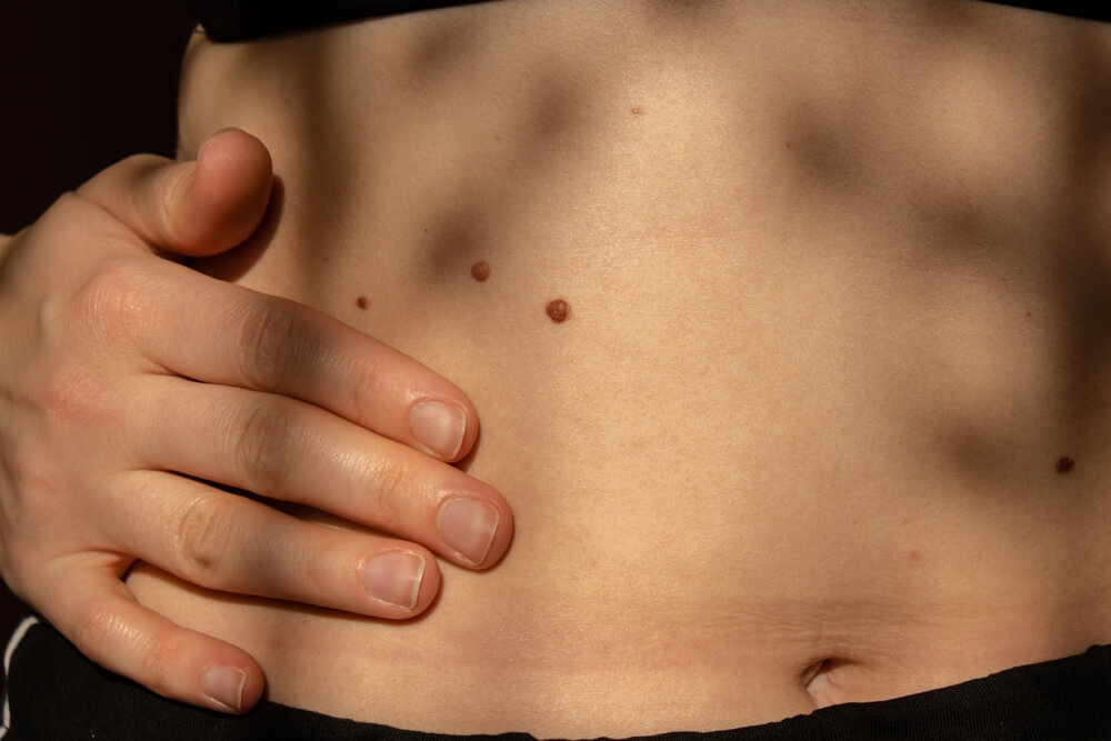 Close-up of a person&apos;s abdomen showing three moles on the skin, with one hand gently resting on the area. The image highlights skin texture and features natural lighting, emphasizing the contrast between the skin and the moles. This visual representation can be used to discuss skin health, mole observation, or dermatological concerns.