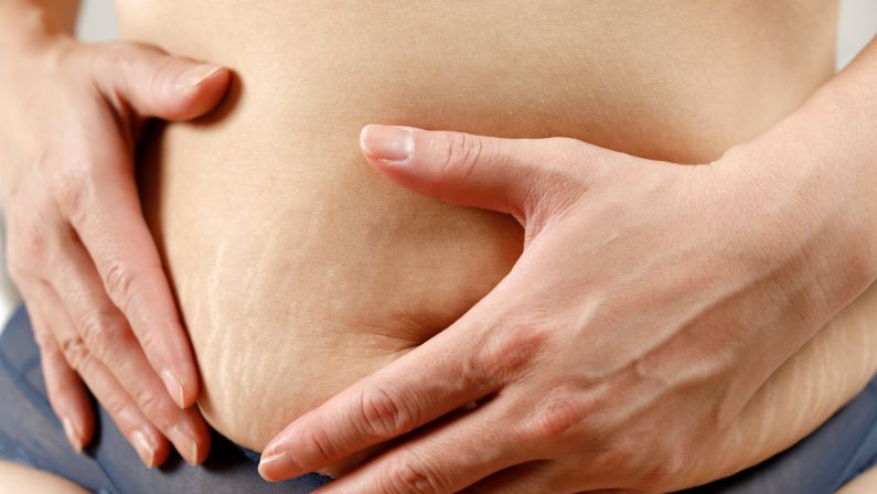 What are the symptoms of stretch marks