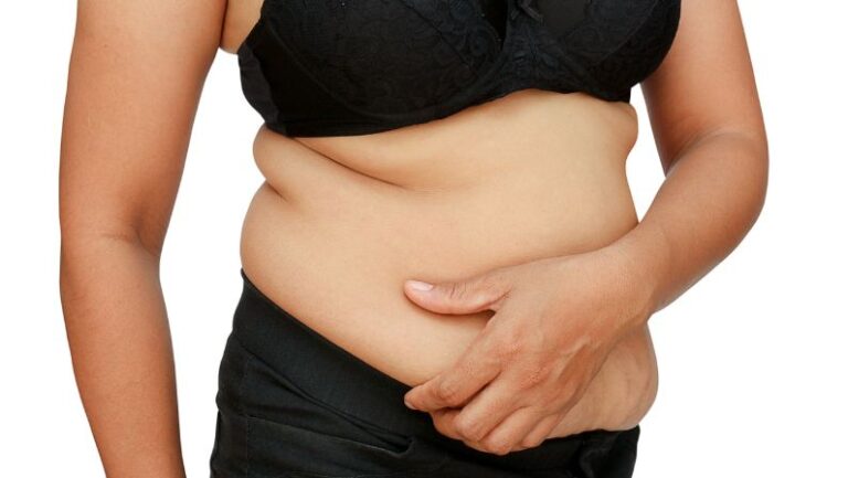 What causes stretch marks