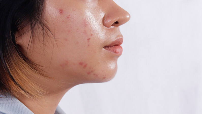 oily skin