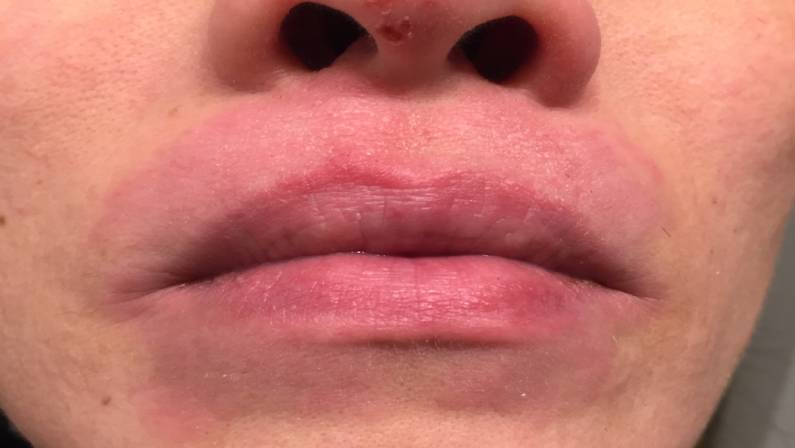 rash with spots