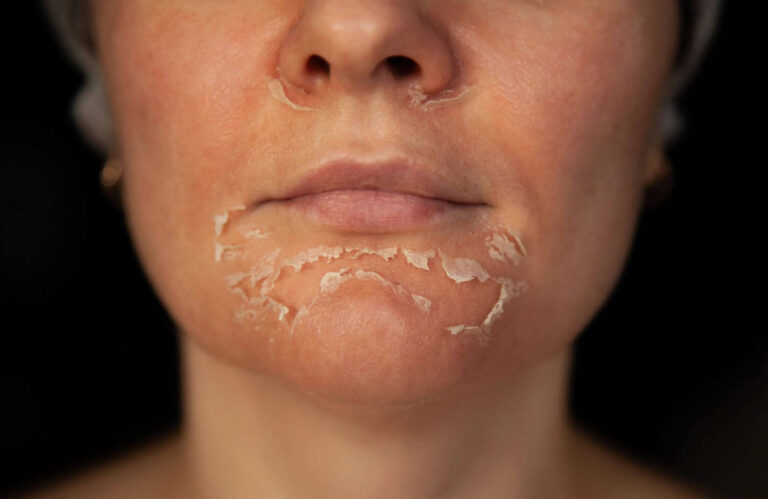 Close-up image of a woman&apos;s chin and lower face showing dry, peeling skin, indicating potential skin irritation or exfoliation. The background is dark, emphasizing the texture of the skin. This image highlights common skin concerns such as dryness, flakiness, or the effects of skincare treatments. It serves as a visual reference for discussions on skincare routines, dermatological issues, or the importance of hydration and skin health.