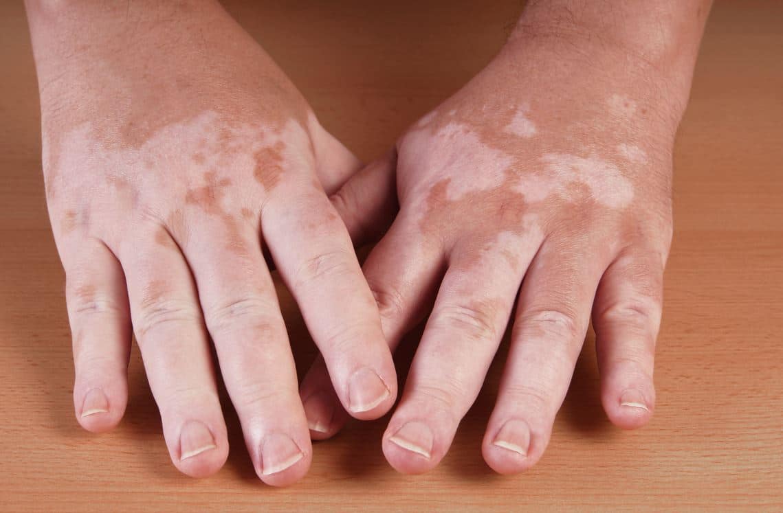 Close-up of two hands on a wooden surface, showing varying skin tones and patterns typical of vitiligo, a skin condition characterized by loss of pigmentation. The hands are positioned with fingers slightly apart, highlighting the contrast between areas of lighter and darker skin. This image visually represents the effects of vitiligo, promoting awareness and understanding of the condition.